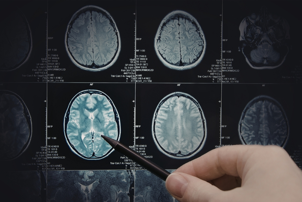 How AVM Embolization Works and Treatment Process